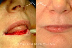 Photo of a patient before and after a procedure. Lip reconstruction with mucosa flap after Mohs cancer removal