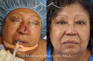 Photo of a patient before and after a procedure. Nasal reconstruction with bilateral midline advancement flaps