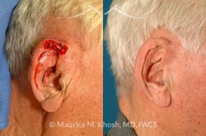 Photo of a patient before and after a procedure. Mohs defect repair of ear