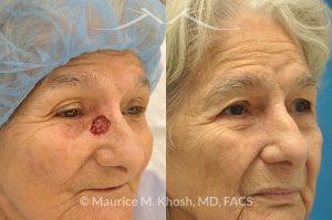 Photo of a patient before and after a procedure. Moh's skin cancer repair of nose