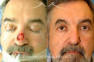 Photo of a patient before and after a procedure. Nose Mohs cancer reconstruction with forehead flap