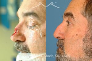 Photo of a patient before and after a procedure. Nose Mohs cancer reconstruction with forehead flap