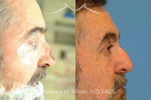 Photo of a patient before and after a procedure. Nose Mohs cancer reconstruction with forehead flap