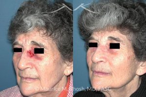 Photo of a patient before and after a procedure. Nose Moh's skin cancer repair
