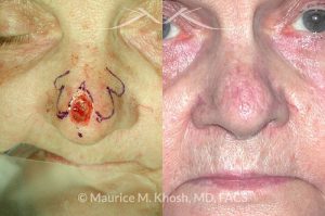 Photo of a patient before and after a procedure. Nose tip Moh's skin cancer reconstruction