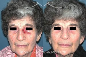 Photo of a patient before and after a procedure. Nose Moh's skin cancer repair