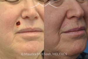 Photo of a patient before and after a procedure. Upper lip Mohs cancer defect repair