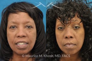 Photo of a patient before and after a procedure. This 55 year old African American lady was interested to addressing lower eyelid puffiness and sagging eyebrow. She underwent lower lid rejuvenation through a trans-conjunctival (inside the eyelid) blepharoplasty and a temporal brow lift.