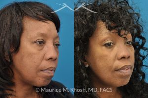 Photo of a patient before and after a procedure. This 55 year old African American lady was interested to addressing lower eyelid puffiness and sagging eyebrow. She underwent lower lid rejuvenation through a trans-conjunctival (inside the eyelid) blepharoplasty and a temporal brow lift.