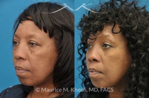 Photo of a patient before and after a procedure. This 55 year old African American lady was interested to addressing lower eyelid puffiness and sagging eyebrow. She underwent lower lid rejuvenation through a trans-conjunctival (inside the eyelid) blepharoplasty and a temporal brow lift.