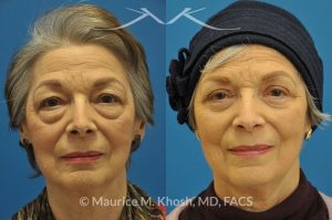 Photo of a patient before and after a procedure. Upper and lower blepharoplasty - 66 year old lady with troublesome puffiness of the lower eyelids and saggy upper eyelids. She was successfully treated with upper blepharoplasty and trans-conjunctival (through the inside of eyelid) lower blepharoplasty. Notice the substantial rejuvenated appearance of the entire face resulting from her eyelid lift procedure.