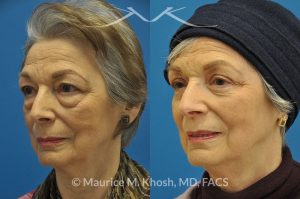 Photo of a patient before and after a procedure. Upper and lower blepharoplasty - 66 year old lady with troublesome puffiness of the lower eyelids and saggy upper eyelids. She was successfully treated with upper blepharoplasty and trans-conjunctival (through the inside of eyelid) lower blepharoplasty. Notice the substantial rejuvenated appearance of the entire face resulting from her eyelid lift procedure.