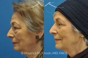 Photo of a patient before and after a procedure. Upper and lower blepharoplasty - 66 year old lady with troublesome puffiness of the lower eyelids and saggy upper eyelids. She was successfully treated with upper blepharoplasty and trans-conjunctival (through the inside of eyelid) lower blepharoplasty. Notice the substantial rejuvenated appearance of the entire face resulting from her eyelid lift procedure.