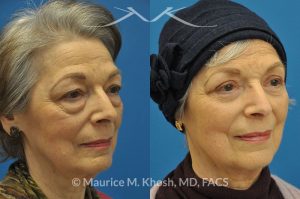 Photo of a patient before and after a procedure. Upper and lower blepharoplasty - 66 year old lady with troublesome puffiness of the lower eyelids and saggy upper eyelids. She was successfully treated with upper blepharoplasty and trans-conjunctival (through the inside of eyelid) lower blepharoplasty. Notice the substantial rejuvenated appearance of the entire face resulting from her eyelid lift procedure.