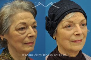 Photo of a patient before and after a procedure. Upper and lower blepharoplasty - 66 year old lady with troublesome puffiness of the lower eyelids and saggy upper eyelids. She was successfully treated with upper blepharoplasty and trans-conjunctival (through the inside of eyelid) lower blepharoplasty. Notice the substantial rejuvenated appearance of the entire face resulting from her eyelid lift procedure.