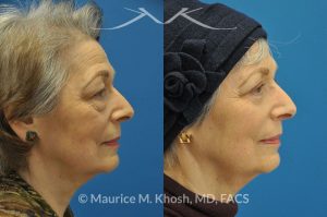 Photo of a patient before and after a procedure. Upper and lower blepharoplasty - 66 year old lady with troublesome puffiness of the lower eyelids and saggy upper eyelids. She was successfully treated with upper blepharoplasty and trans-conjunctival (through the inside of eyelid) lower blepharoplasty. Notice the substantial rejuvenated appearance of the entire face resulting from her eyelid lift procedure.