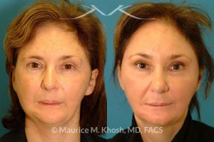 Photo of a patient before and after a procedure. Brow lift