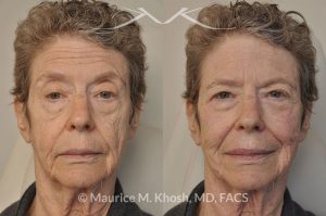 Photo of a patient before and after a procedure. Voluma filler