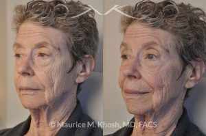 Photo of a patient before and after a procedure. Voluma filler