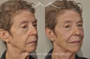 Photo of a patient before and after a procedure. Voluma filler