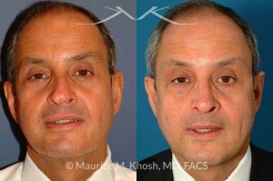 Photo of a patient before and after a procedure. Nasal valve repair septoplasty