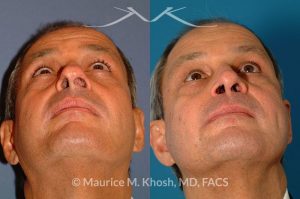 Photo of a patient before and after a procedure. Nasal valve repair septoplasty