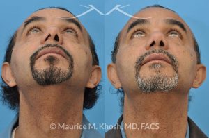Photo of a patient before and after a procedure. Nasal valve repair septoplasty