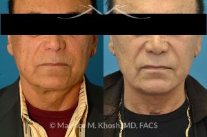 Photo of a patient before and after a procedure. Facelift - This 73 year old gentleman, with past facelift surgery, complained of central neck skin laxity and 