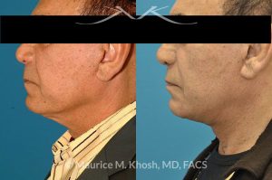 Photo of a patient before and after a procedure. Facelift - This 73 year old gentleman, with past facelift surgery, complained of central neck skin laxity and 'turkey wattles'. The neck skin and muscle was tightened with the Grecian Urn direct neck lift technique.