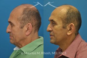 Photo of a patient before and after a procedure. Facelift, neck lift - 66 year old man who wanted tightening of neck skin and improvement in the jowls while maintaining a natural an un-operated look. A conservative SMAS facelift with simultaneous neck lift helped achieve his desired goals.