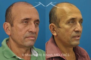 Photo of a patient before and after a procedure. Facelift, neck lift - 66 year old man who wanted tightening of neck skin and improvement in the jowls while maintaining a natural an un-operated look. A conservative SMAS facelift with simultaneous neck lift helped achieve his desired goals.