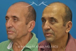 Photo of a patient before and after a procedure. Facelift, neck lift - 66 year old man who wanted tightening of neck skin and improvement in the jowls while maintaining a natural an un-operated look. A conservative SMAS facelift with simultaneous neck lift helped achieve his desired goals.