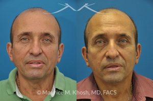 Photo of a patient before and after a procedure. Facelift, neck lift - 66 year old man who wanted tightening of neck skin and improvement in the jowls while maintaining a natural an un-operated look. A conservative SMAS facelift with simultaneous neck lift helped achieve his desired goals.