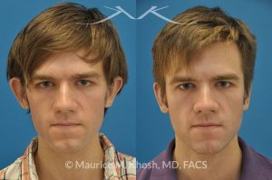 Photo of a patient before and after a procedure. Otoplasty - Otoplasty procedure, before and after photos.