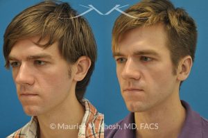 Photo of a patient before and after a procedure. Otoplasty