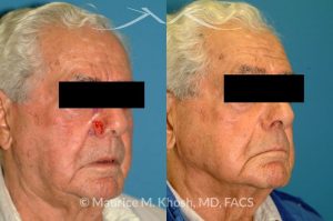 Photo of a patient before and after a procedure. Nose alar Moh's skin cancer reconstruction - before and after photos.