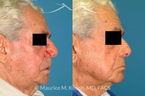 Photo of a patient before and after a procedure. Nose alar Moh's skin cancer reconstruction - before and after photos.