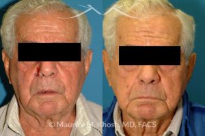 Photo of a patient before and after a procedure. Nose alar Moh's skin cancer reconstruction - before and after photos.