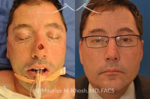 Photo of a patient before and after a procedure. Nose dorsum Moh's skin cancer reconstruction