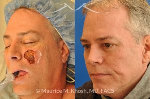 Photo of a patient before and after a procedure. Cheek reconstruction