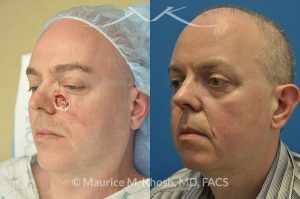 Photo of a patient before and after a procedure. Cheek reconsturction Mohs skin cancer defect