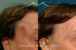 Photo of a patient before and after a procedure. Temple skin reconstruction with skin graft