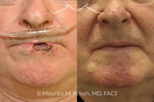 Photo of a patient before and after a procedure. Lip recnostruction for Mohs cancer defect