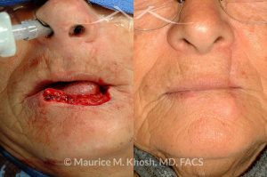 Photo of a patient before and after a procedure. Lip reconstruciton with Abbe Estelander flap