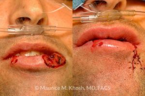 Photo of a patient before and after a procedure. Lip reconstruction