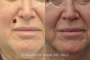 Photo of a patient before and after a procedure. Upper lip Mohs cancer defect repair