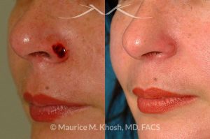 Photo of a patient before and after a procedure. Mohs skin cancer repair of nose - before and after photos.