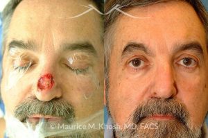 Photo of a patient before and after a procedure. Nose Mohs cancer reconstruction with forehead flap - before and after photos.