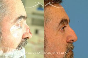 Photo of a patient before and after a procedure. Nose Mohs cancer reconstruction with forehead flap - before and after photos.