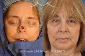 Photo of a patient before and after a procedure. Nose tip reconstruction Mohs skin cancer defect - before and after photos.